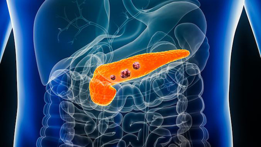 3d illustration of pancreas with tumors